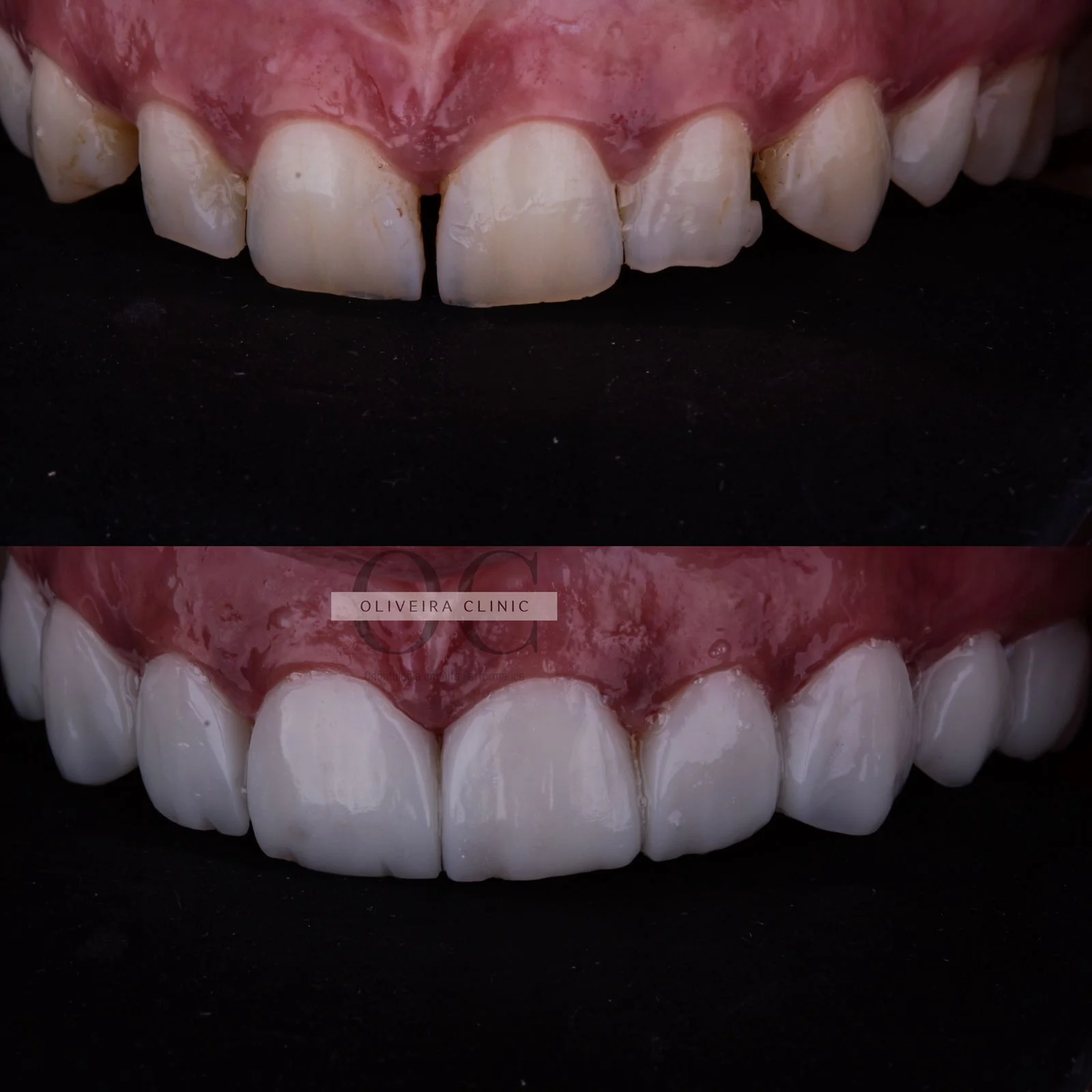 Antes e depois — Lentes em Cerâmica Premium na Oliveira Clinic