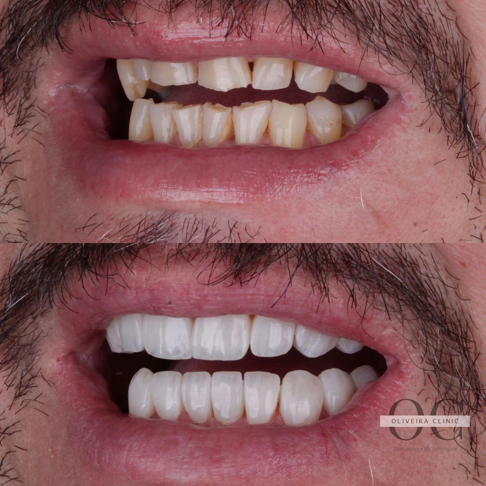 Antes e depois — Reabilitação Inferior Completa na Oliveira Clinic