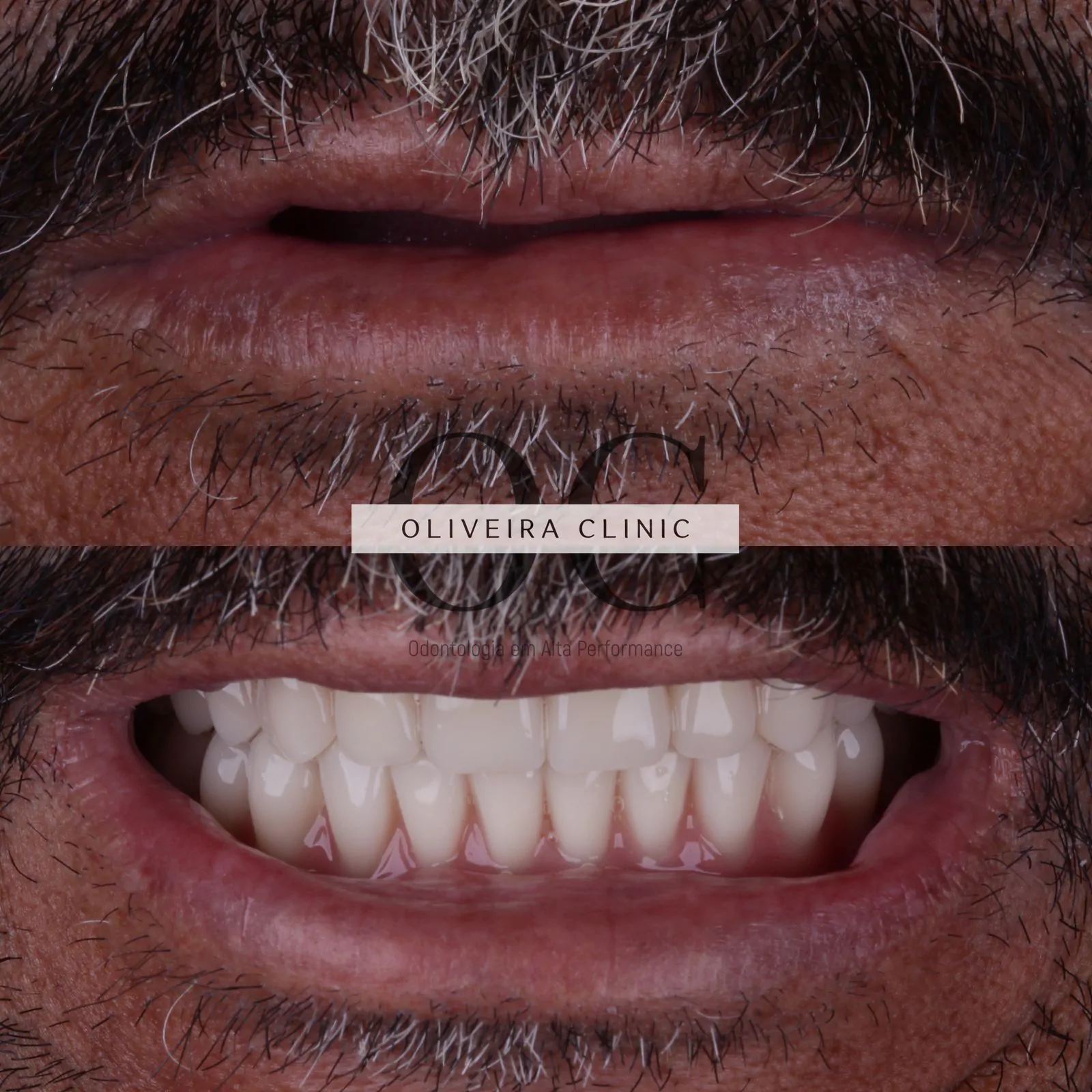 Antes e depois de reabilitação com implantes dentários protocolo fixo superior e inferior — paciente da Oliveira Clinic em São Paulo
