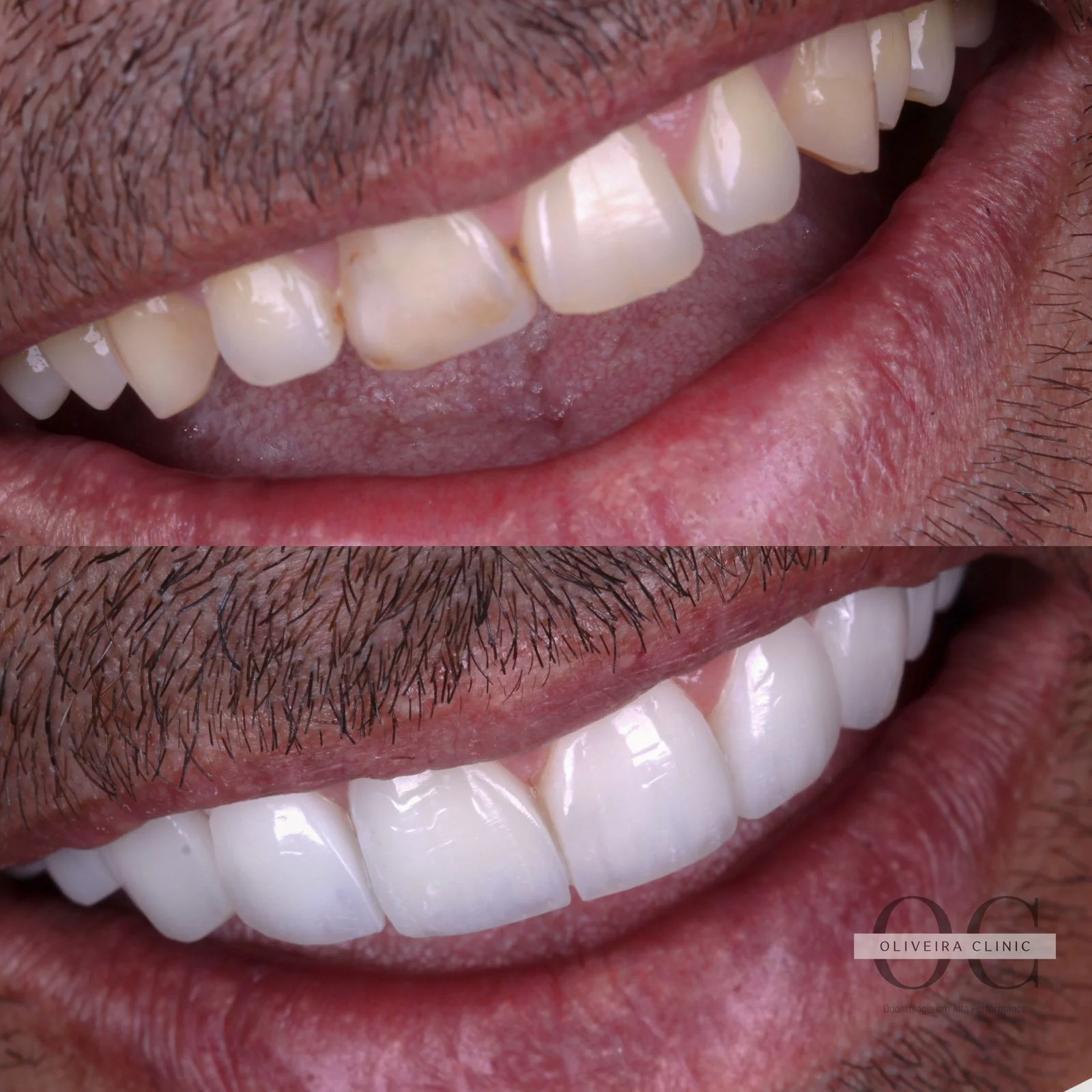 Antes e depois — Reabilitação Masculina Completa na Oliveira Clinic