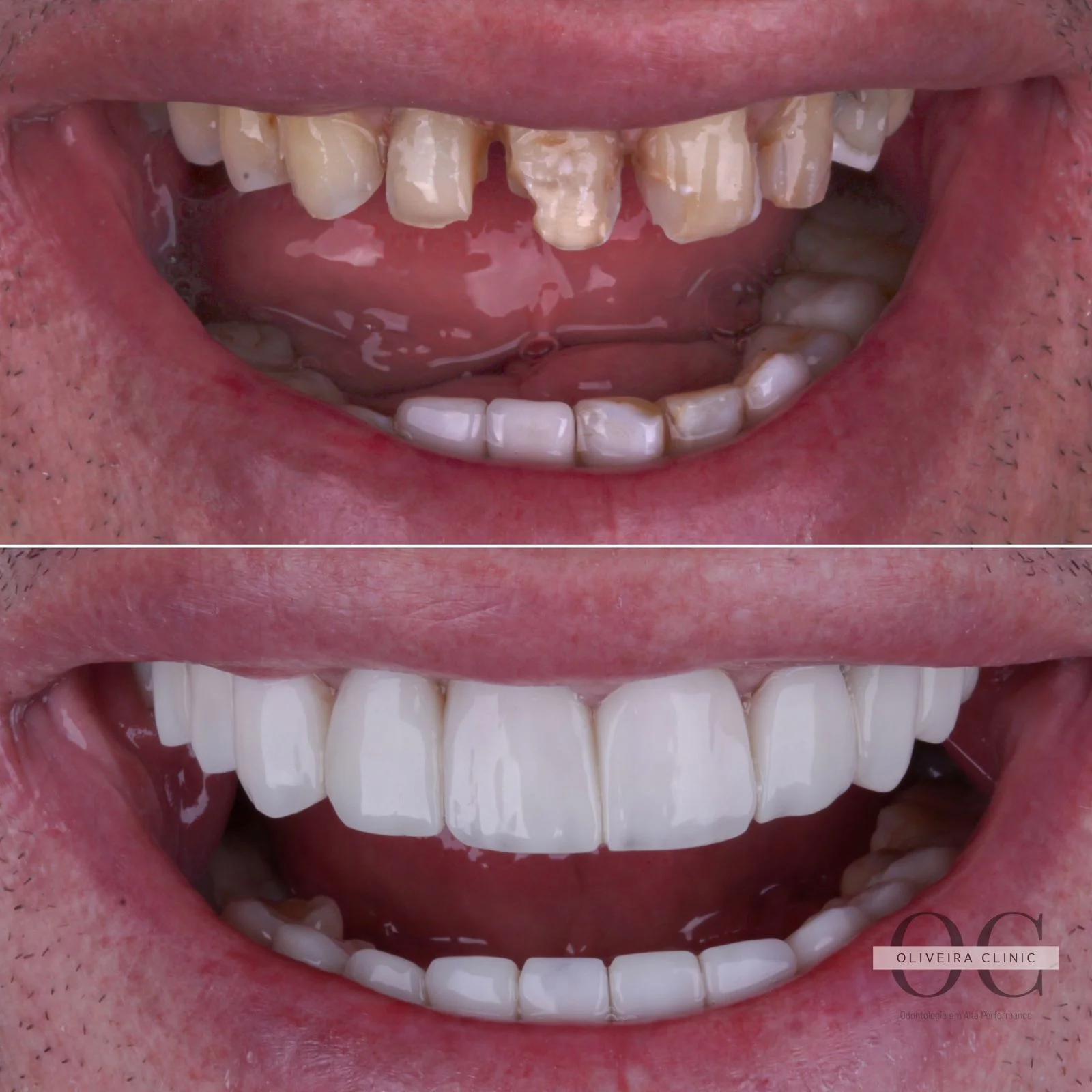 Antes e depois — Protocolo Sobre Implantes Superior na Oliveira Clinic