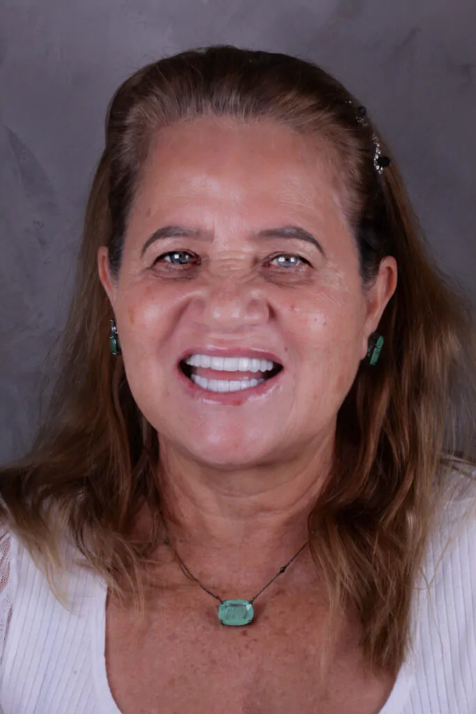 Paciente da Oliveira Clinic com lentes dentais — sorriso natural e harmônico